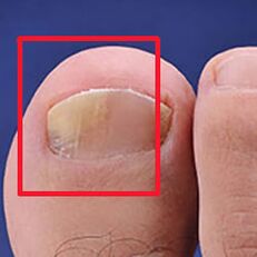 Micosis ou fungos de unhas
