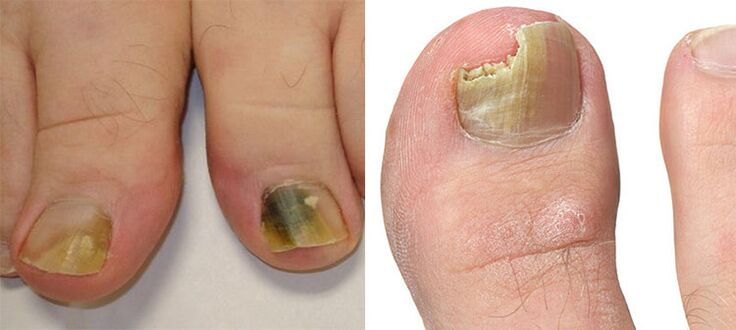 Onychomicose - Destruição de unhas com um fungo