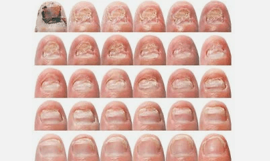 Como é o fungo das unhas