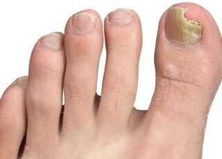 Sintomas de fungo das unhas