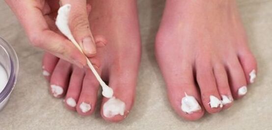 tratamento de fungo nas unhas com pomada