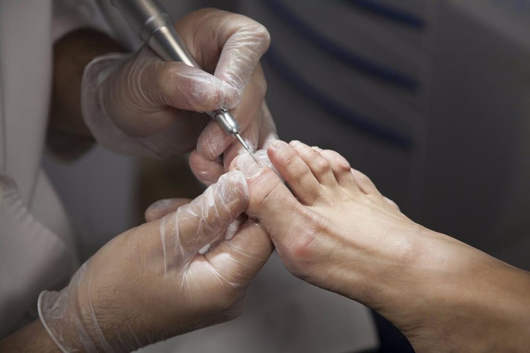 tratamento profissional para fungos nas unhas