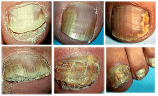 tipos e formas de fungos nas unhas dos pés