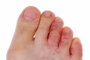 infecção fúngica dos dedos dos pés