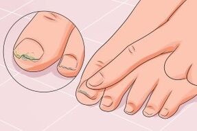 infecção fúngica nas unhas