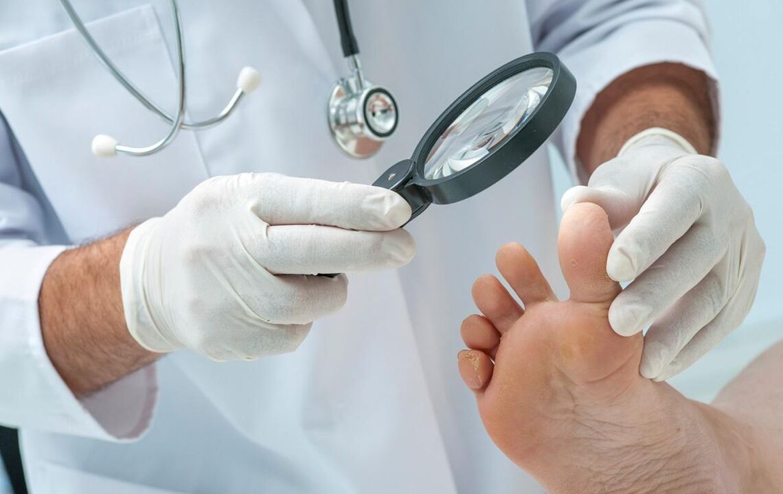 médico examina unhas em busca de fungos