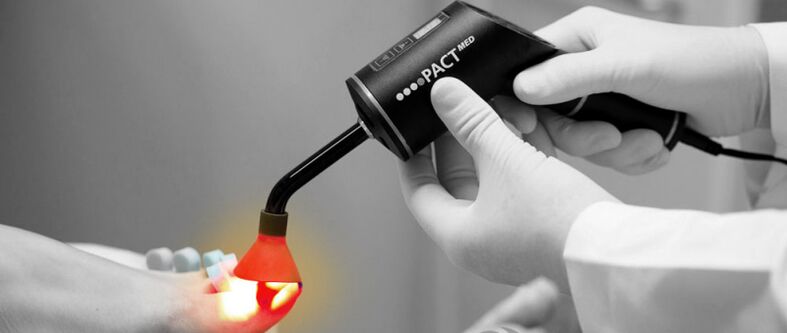 tratamento a laser para fungos nas unhas dos pés